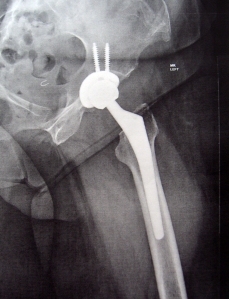 Another view of my New Hip - by Dr. Springer - OrthoCarolina